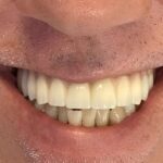 Implantología en San Pedro de Alcántara - Clinica Dental Ana Moreno
